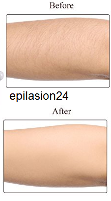 قیمت اپیلاسیون تهرانپارس