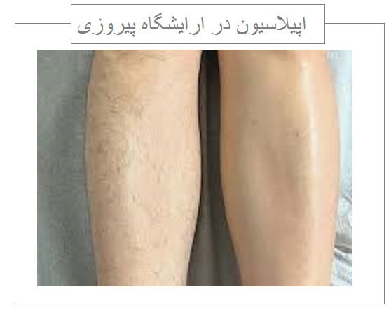 اپیلاسیون ارایشگاه در پیروزی